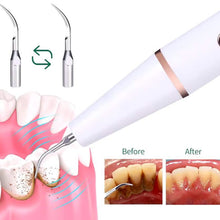 Load image into Gallery viewer, Advanced Electric Teeth Cleaning Tool Powerful Calculus Remover & Tartar Eraser